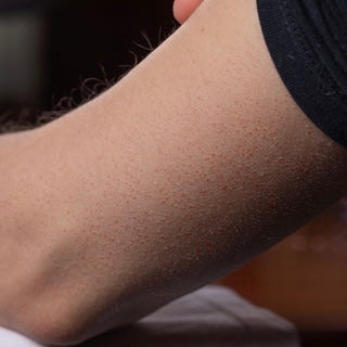WHAT IS KERATOSIS PILARIS AND HOW TO DEAL WITH IT