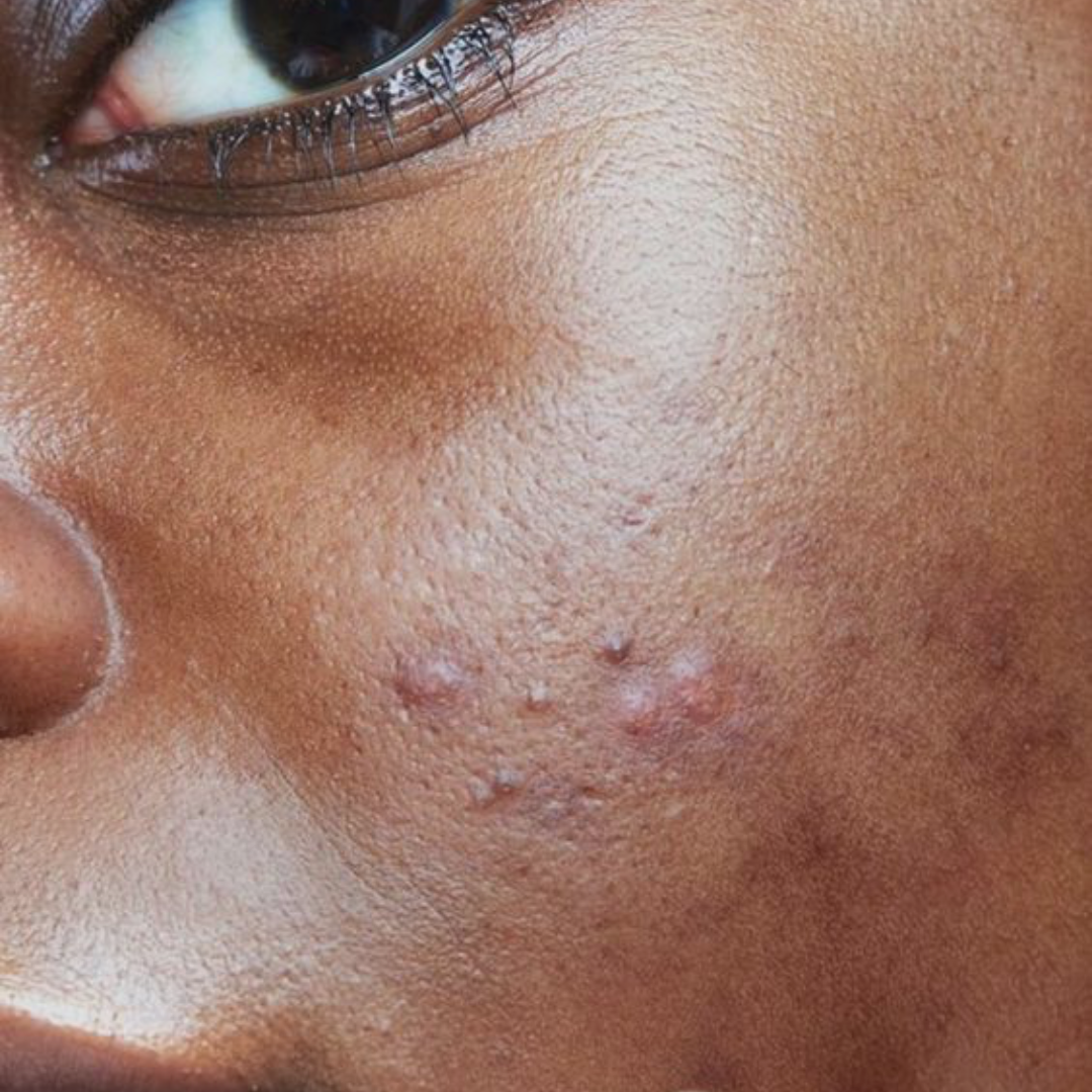 Skincare Tips: How to Stop & Prevent Breakouts