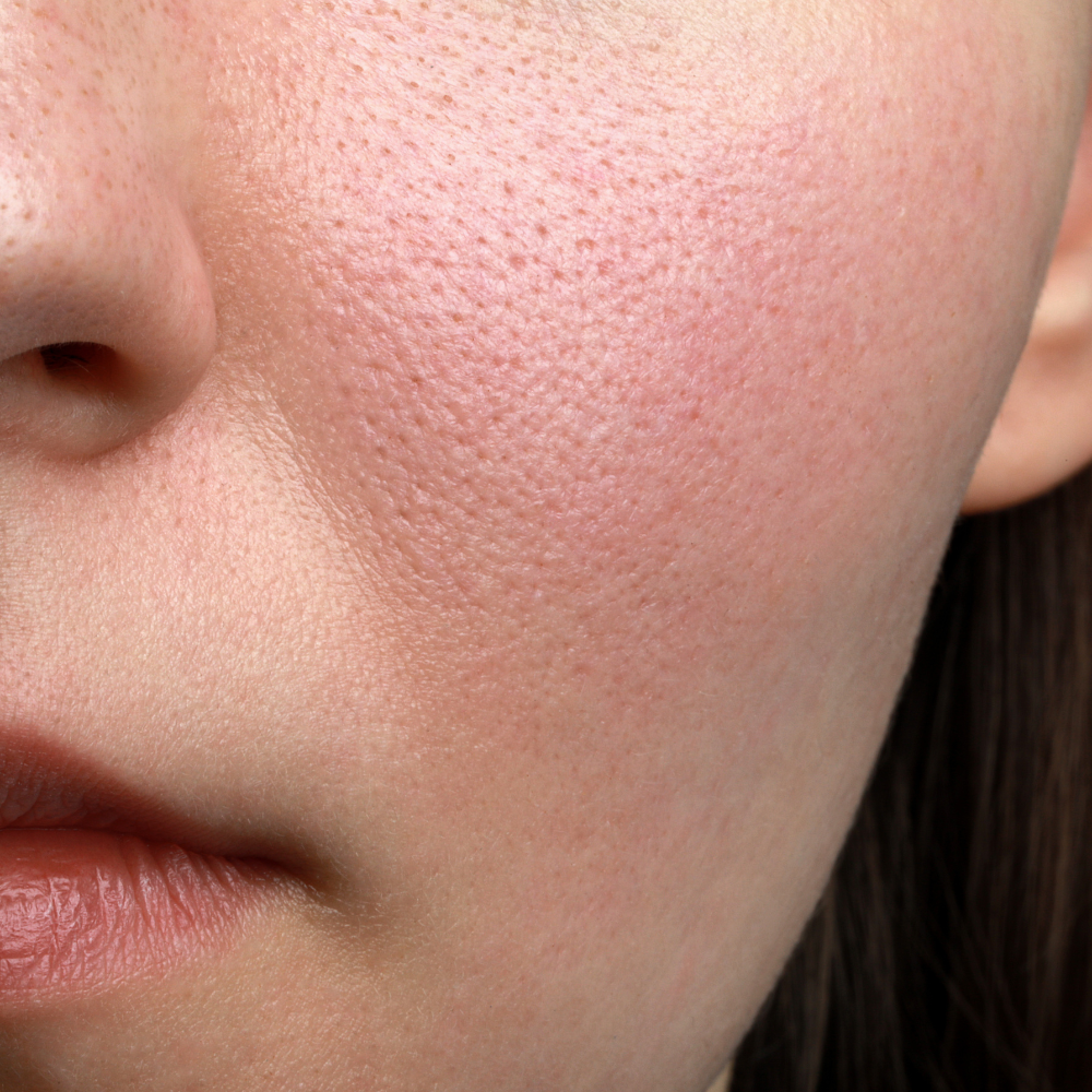 Skin Type 7: DRY + SENSITIVE & RED